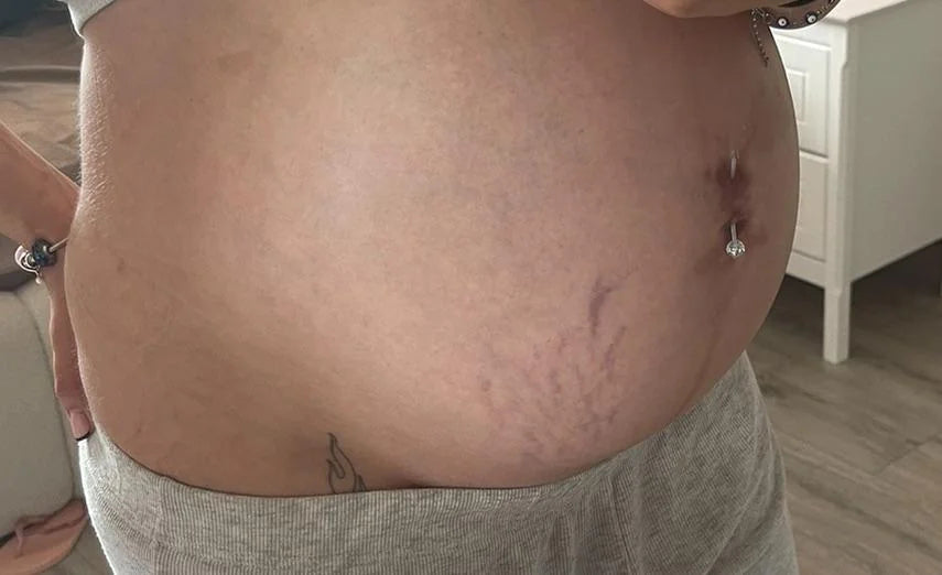 Postpartum stretch marks before starting the Dermosol protocol