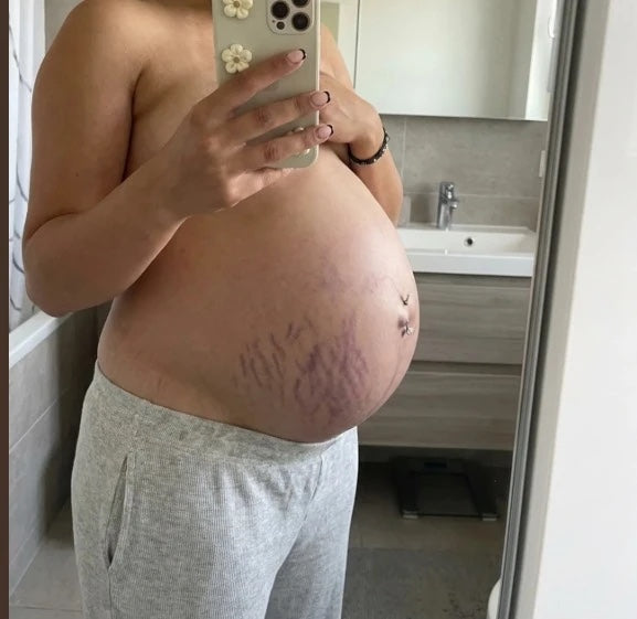Two days before labor — fresh stretch marks across the belly