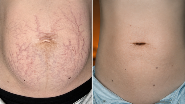 Before and After