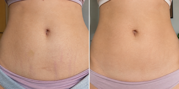 Before and After