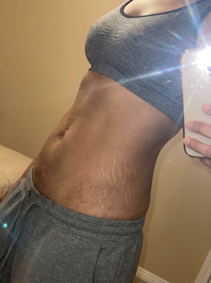 Silver stretch marks left behind after rapid weight loss