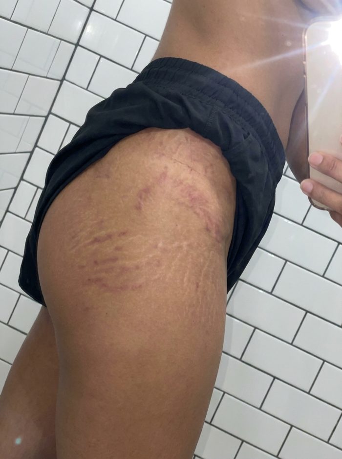 The stretch marks the bulk left behind — week 0 of the protocol